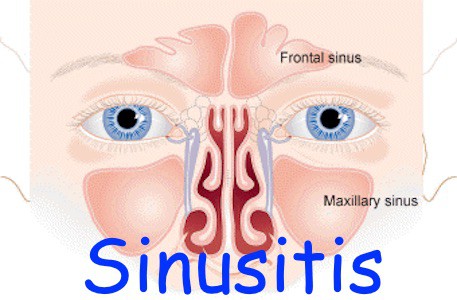 Treatments For Sinusitis