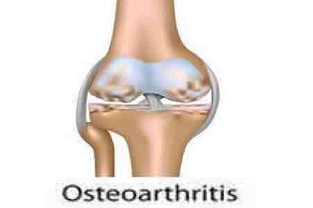 Osteoarthritis Of The Knee