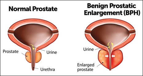 Benign Prostatic Hyperplasia, Prostatic Hyperplasia