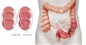How Colorectal Cancer Looks In Your Colon